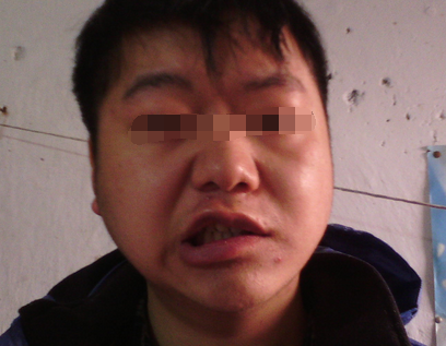 男大夫因贪凉造成面瘫，警惕贪凉引发健康危机